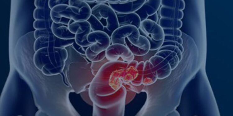 SUS adota novo exame para rastrear câncer colorretal na população